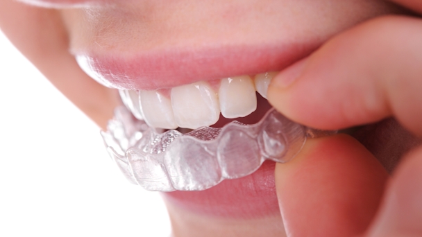 A retainer may be uncomfortable to get, but worth it in the end