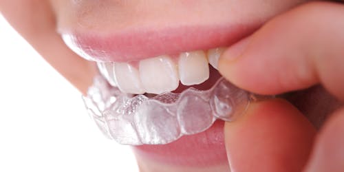 A retainer may be uncomfortable to get, but worth it in the end